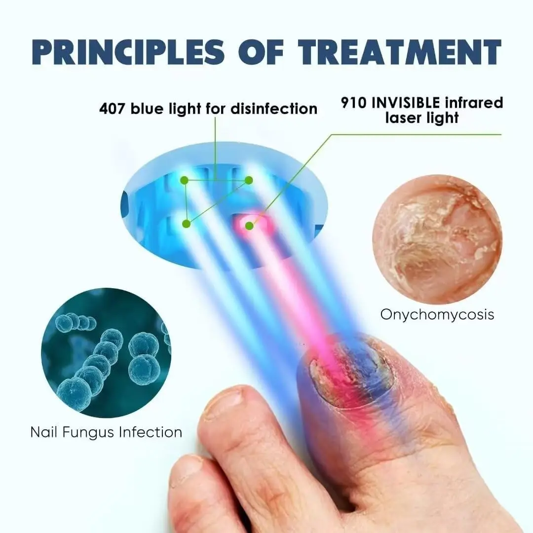 Professional Nail Fungus Laser Treatment Device Fungus Fast Repair Onychomycosis Toenail Laser Device Nail Mushroom treatment