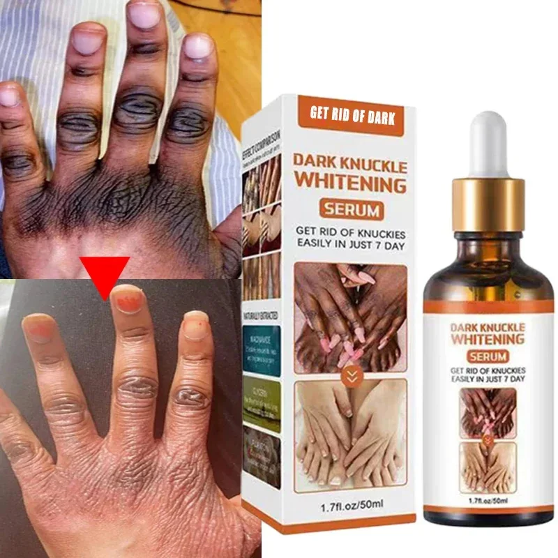 Dark Knuckles Fast Whitening Serum Hand Knuckle Removal Melanin Essence Elbows Knee Stains Remover Products Brightening Care