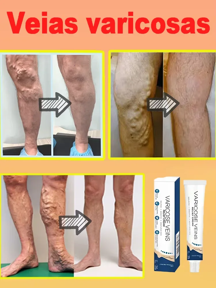 Varicose Veins cream Natural Herbal Skin Improved Blood Circulation Swelling Relief and Spider Vein Treatment