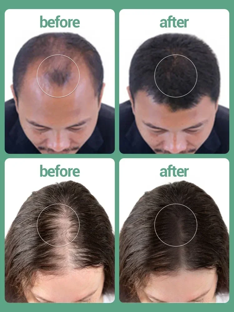 Tratamento líquido do crescimento do cabelo para homens e mulheres, perda do Anti-cabelo, tratamento