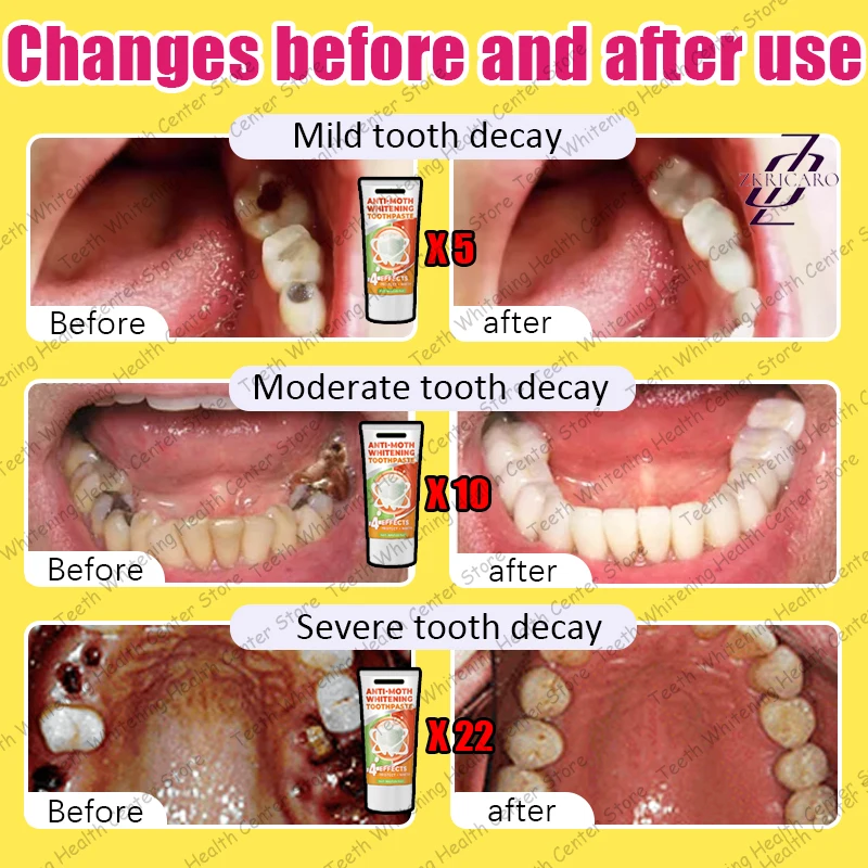 Risolvi problemi di carie dei denti e mantengono i denti sani