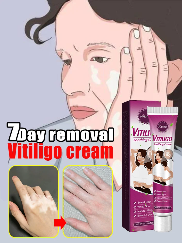 

7 day fast eliminate vitiligo cream effectively resists white spot and improves skin immunity