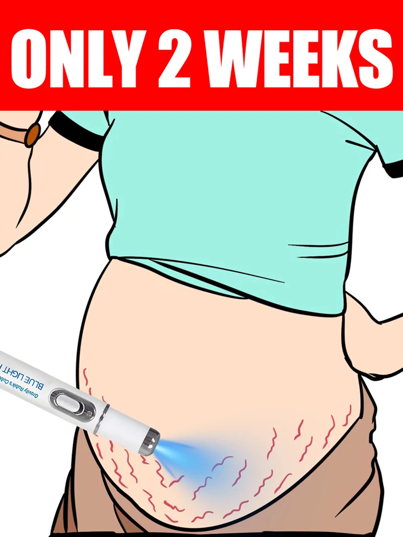 Striae Laser Device Eliminate Body Stretch Marks Products