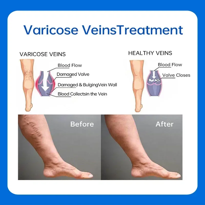 Efficace crema per il trattamento delle vene Varicose rimuovi le strisce di sangue rosso Varicose vasculite flebite rafforza la salute dei capillari