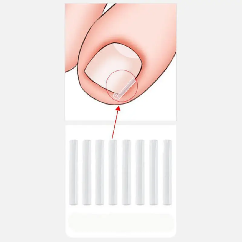 50Pcs Ingrown Toe Nail Treatment Elastic Patch Sticker Straightening Clip Brace Pedicure Tool Ingrown Toenail Correction Tool
