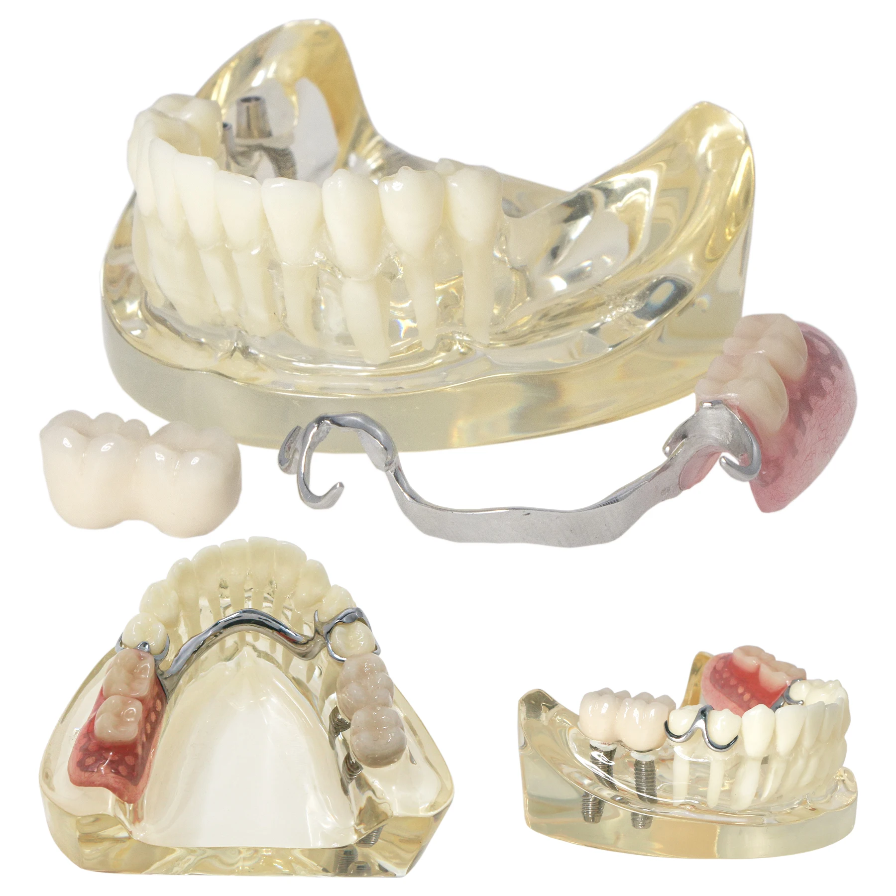 Dental Teeth Model Typodont Restoration Model Steel Bracket Model with Partial Denture Demo 2 Implants