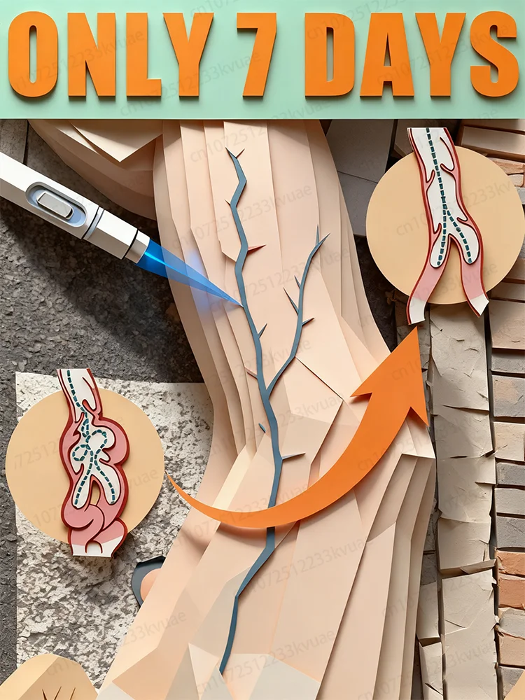 قلم معالجة الوريدي بالليزر من الجيل الثاني، يستخدم لعلاج الدوالي