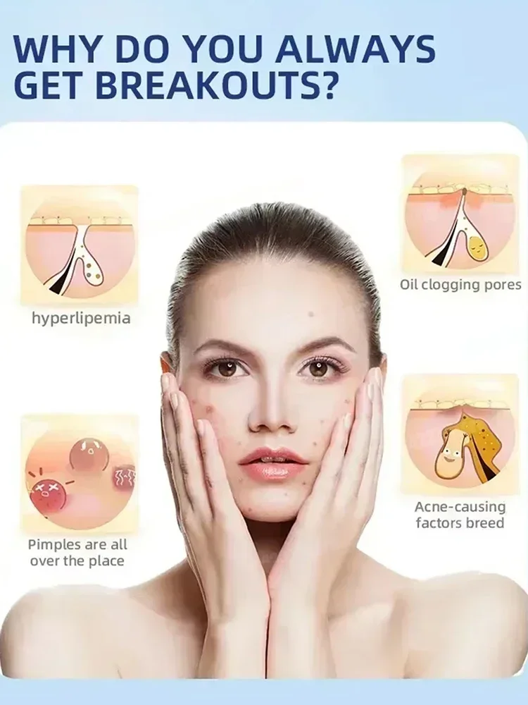 3RD محلول حمض الساليسيليك جوهر حب الشباب إزالة بقعة تقليص المسام السيطرة على النفط سطع المصل ، تقليل حب الشباب ، ترطيب ، تهدئة