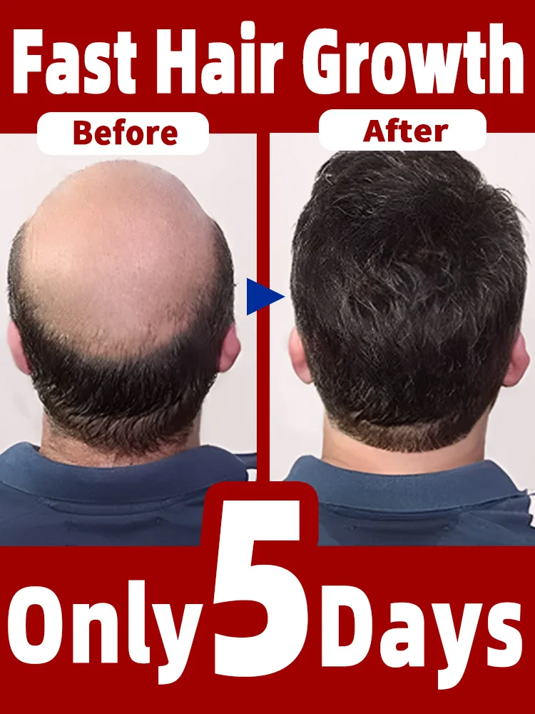 

98% of customers repurchase, have more and more hair, say goodbye to baldness