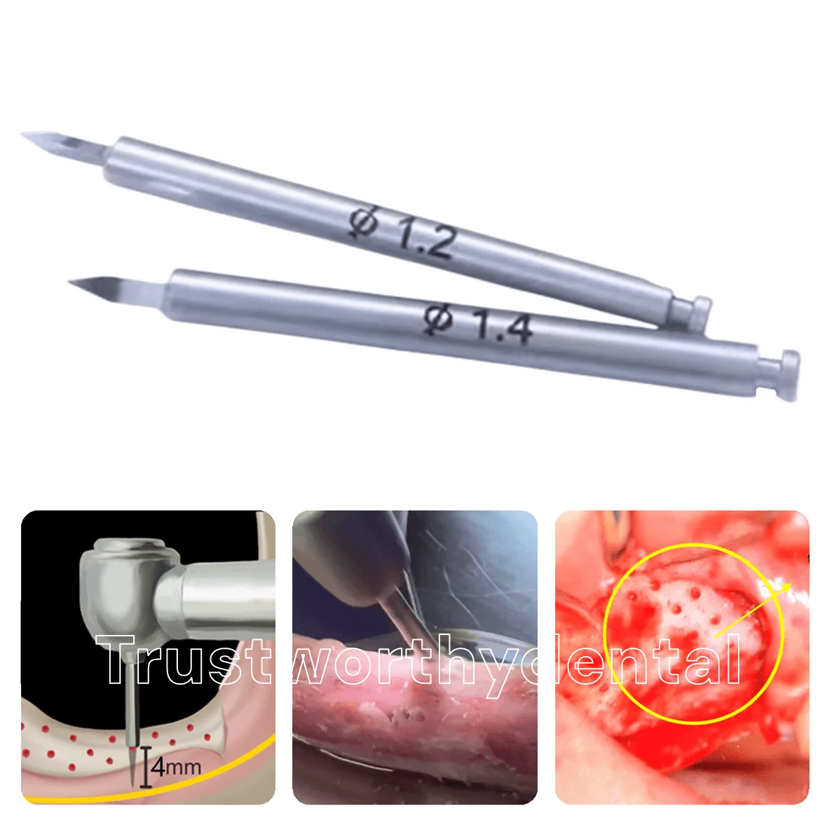 Dental Nutrient Drill Bone GBR Drill Increment Implant Nutrient Hole Drill Promote New Bone Generation Formation Bone Drill