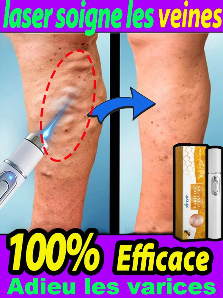 

Varicosse Cream Laser