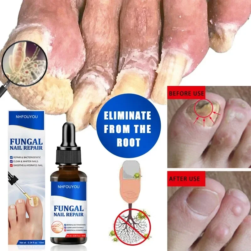 Fungal Nail Treatment Oil Fungus Removal Gel Anti Infection Cream Foot Repair Essence Toe Nail Fungal Nail Removal 10ML