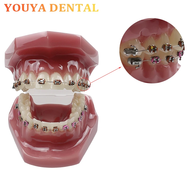 

Dental Orthodontic Model with Metal Brackets Orthodontic Tooth Model Dental Student Education Training Model
