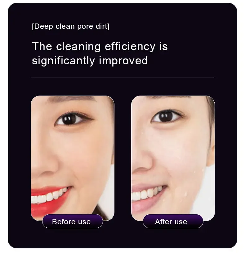 Dispositivo facial de microagulha de radiofrequência, terapia de íon de luz led, haste de tratamento de levantamento de pele do pescoço, ferramenta de aperto de rugas