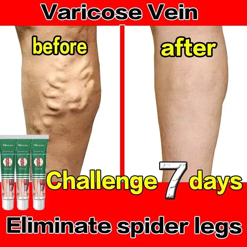 Varicose Vein Treatments Cream Effective Relieve Legs Dilated Vasculitis Phlebitis Natural Formula Ointment For Varicose Veins