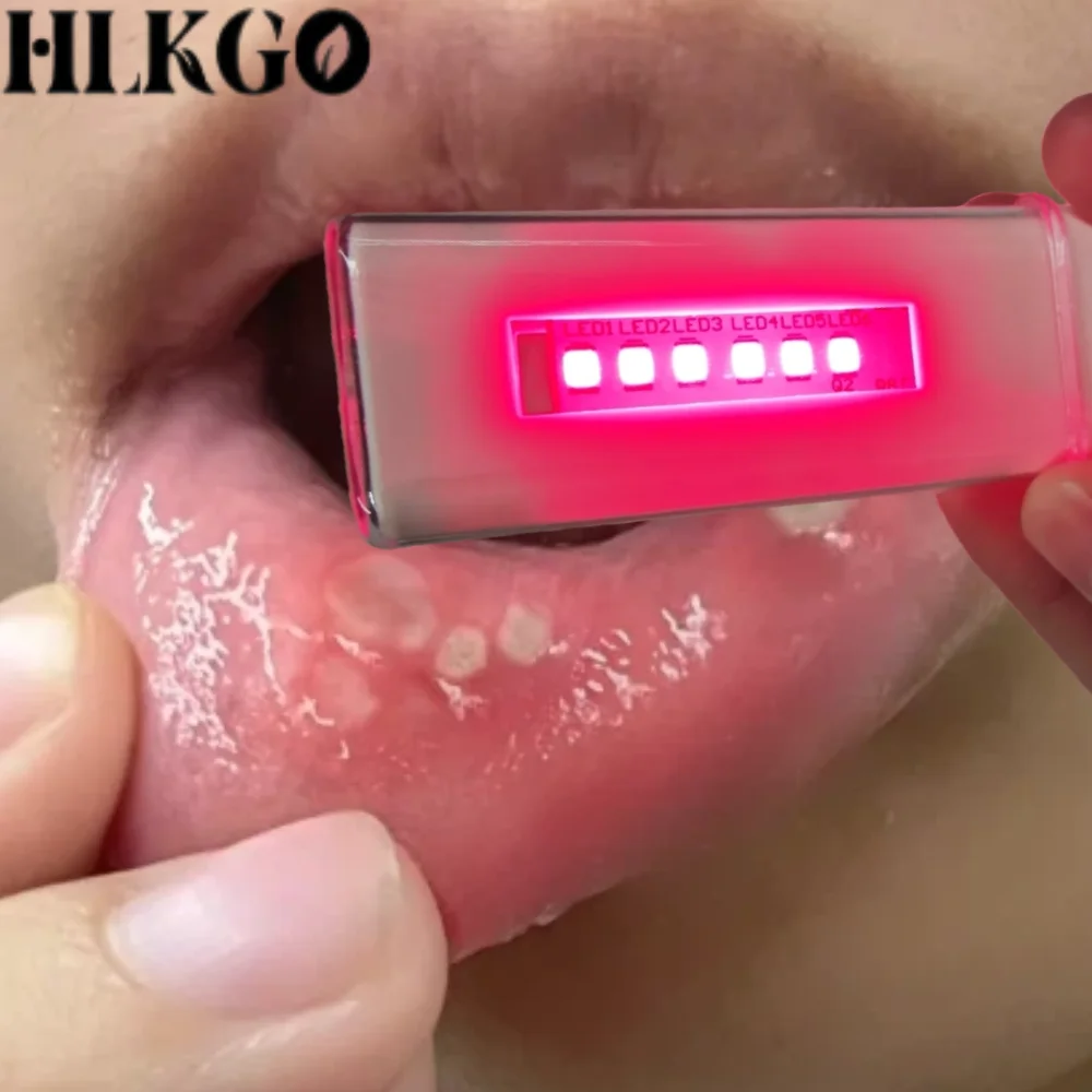 

Fast Canker Sore Relief Device Handheld Red Light Therapy to Soothe Pain, Reduce Swelling and Disinfect