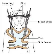 Professional Medical Halo-Vest