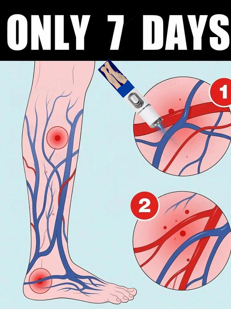 La Generation-2 Laser dit au revoir aux varices des jambes d'araignee خلال 7 أيام #1