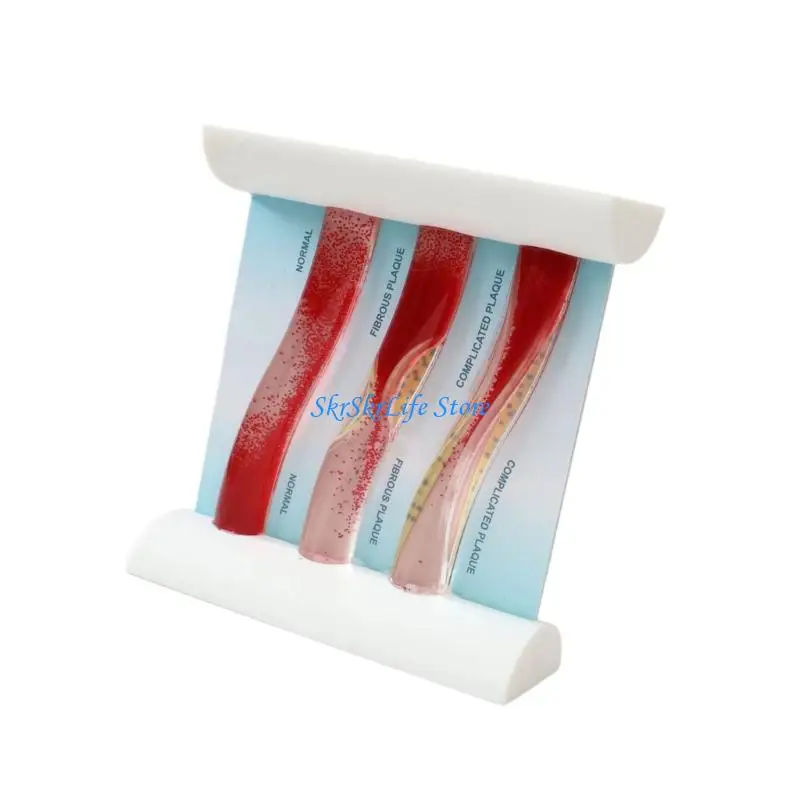 E65E Life Size Vascular Model Demonstrating Blood Circulation And Plaque Formation