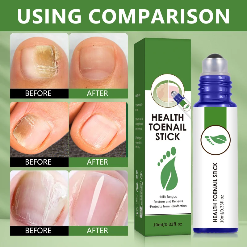 

Уход за ногтями Роликовый раствор Ежедневное очищение Сомягчает увлажняет Восстанавливает онихомикоз Осветляет укрепляет питательный уход за ногтями