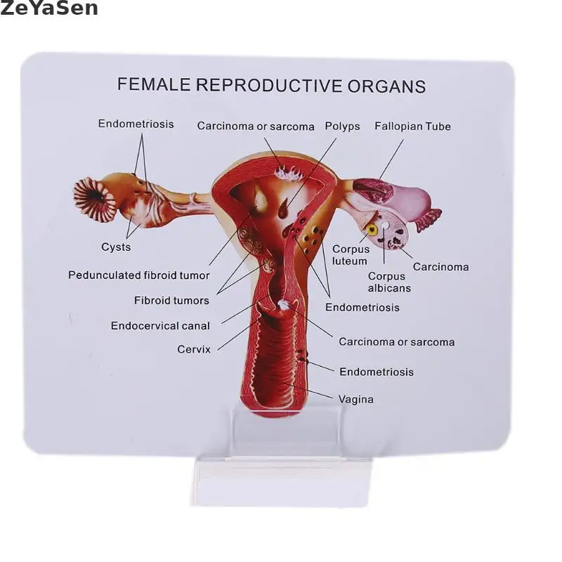 Medical props model Human Female Pathological Uterus Ovary Model Anatomical Disease Pathology Medical Lesion ForBiology Teaching