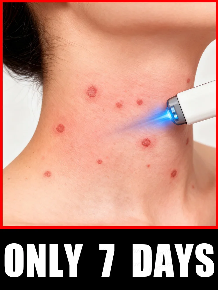 

2025 New Upgrade Blue Laser Solve Wart Tool