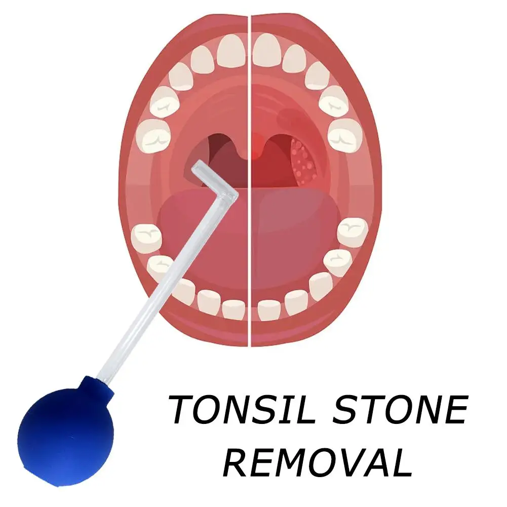 Tonsil Steenverwijderingsgereedschap Handmatige Verwijderaar Mondreiniging Verzorgingstool Oorsmeer Tonsil Steen Zuigbal Reiniger Amandelen Steenverwijderaar