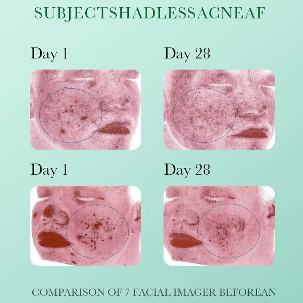 BIOAQUA Acido Salicilico Rimozione Dell'acne Siero Viso Idratante Riparatore Anti Acne Rimozione Anti-età Essenza Del Viso Cura Della Pelle