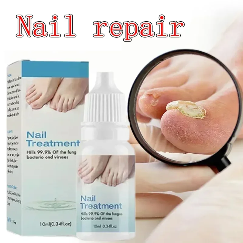 Óleo eficaz para reparo de unhas fúngicas, essência para reparo de dedos dos pés, creme anti-infecção poderoso para tratamento de unhas fúngicas