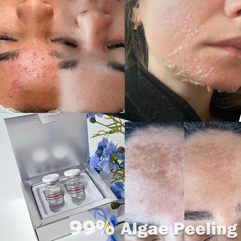 S Stärkste 99 % Spongilla-Gewürze, Algenschalen, Bio-Gewürz, Peeling, Melasma, Sommersprossen, Fleckenentfernung, Anti-Aging-Algenschalen-Pulver
