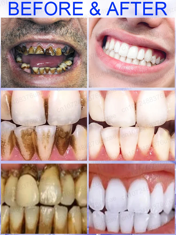 Reparar, prevenir dentes irritantes, remover gesso dental, dor de dente, dentes brancos, aliviar o mau hálito