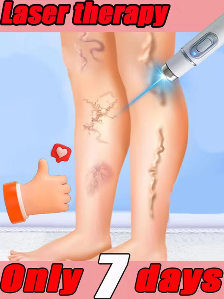 

Модернизированная версия инструмента второго поколения, лазерный ремонт синего света, варикозное расширение вен