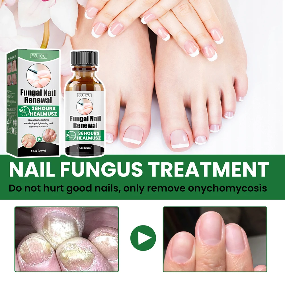 30 مللي علاجات أظافر قوة إضافية تو فطريات الأظافر تجديد القلم سريع المفعول قلم إصلاح الأظافر لتلف الأظافر المتغيرة اللون