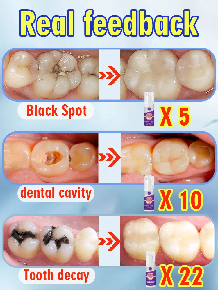 Solve cárie e problema de cárie dentária