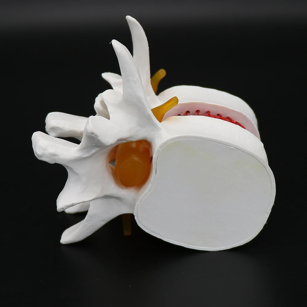 1Piece PVC Lumbar Vertebral Spine Model Teaching Aid Tool Demonstration Model Human Lumbar Disc Herniation Model