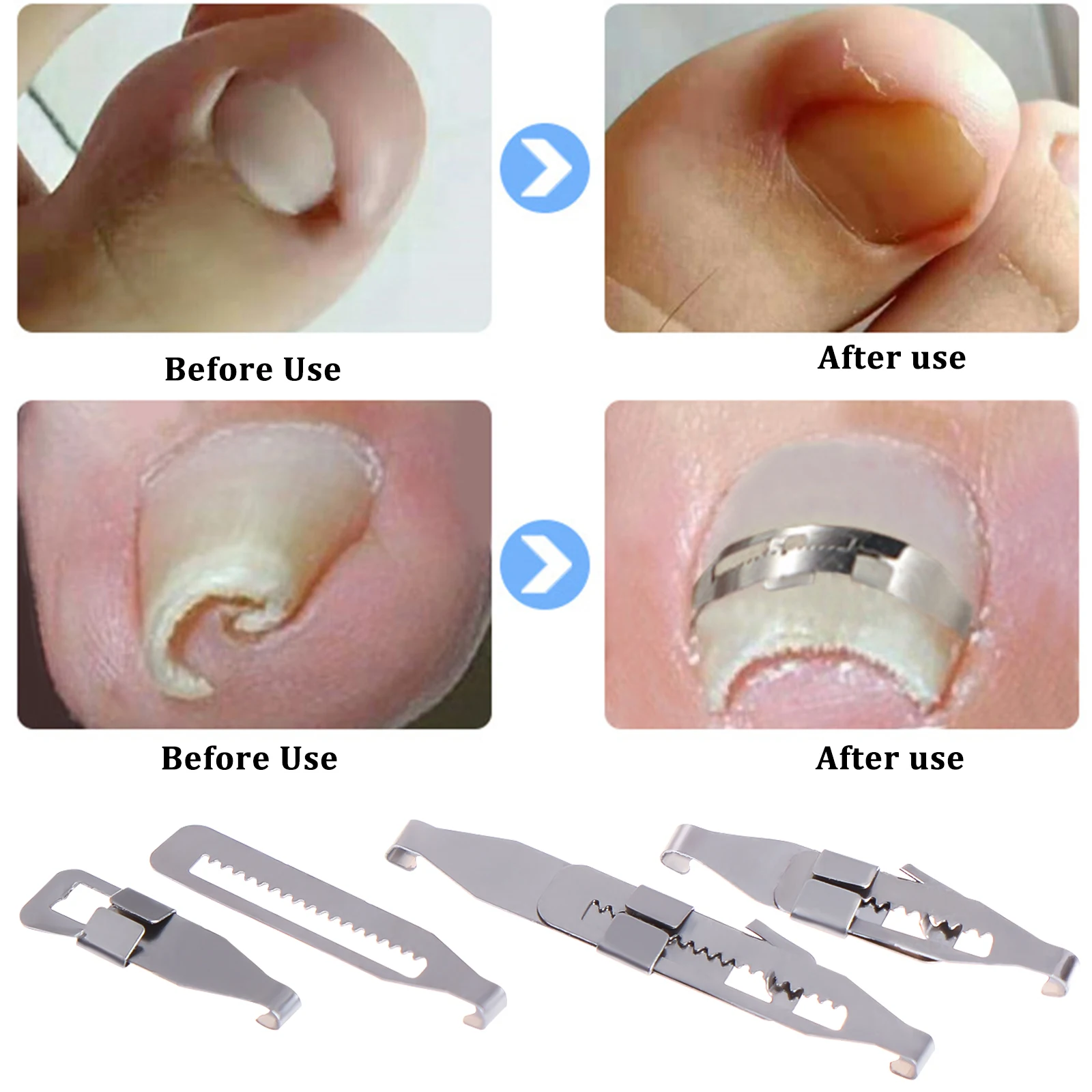 4/10pc Carbon Steel Ingrown Toenail Pedicure Tool Straightening Correction Clip Curved Brace Toenail Thick Paronychia Correction