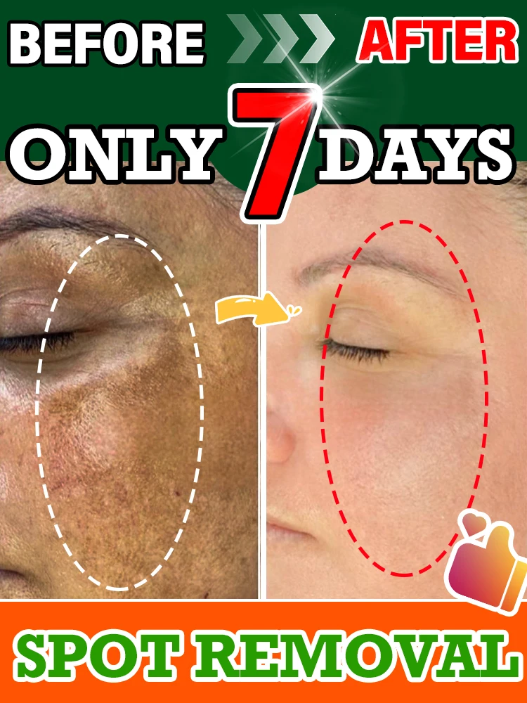 

Vitamin B3 Spot Removal Serum Targets Sun Spots, Age Spots & Dark Patches with Natural Brightening Formula