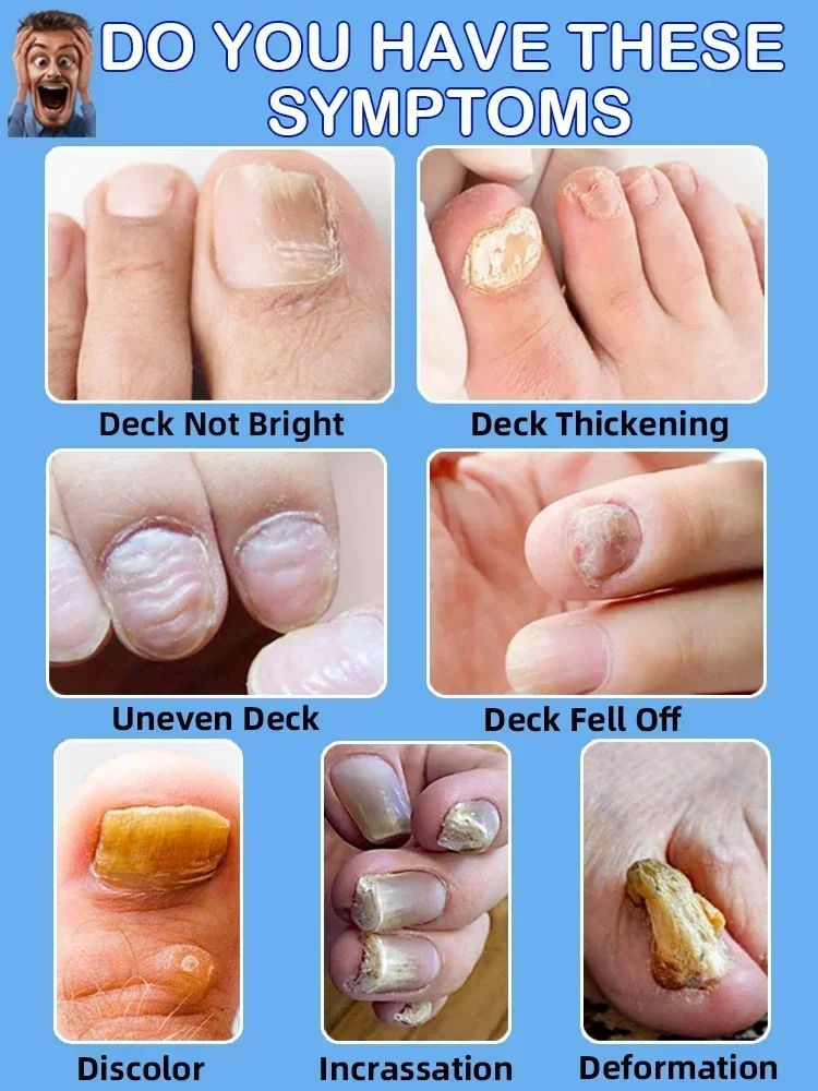 Problèmes d'ongles des pieds entièrement résolus