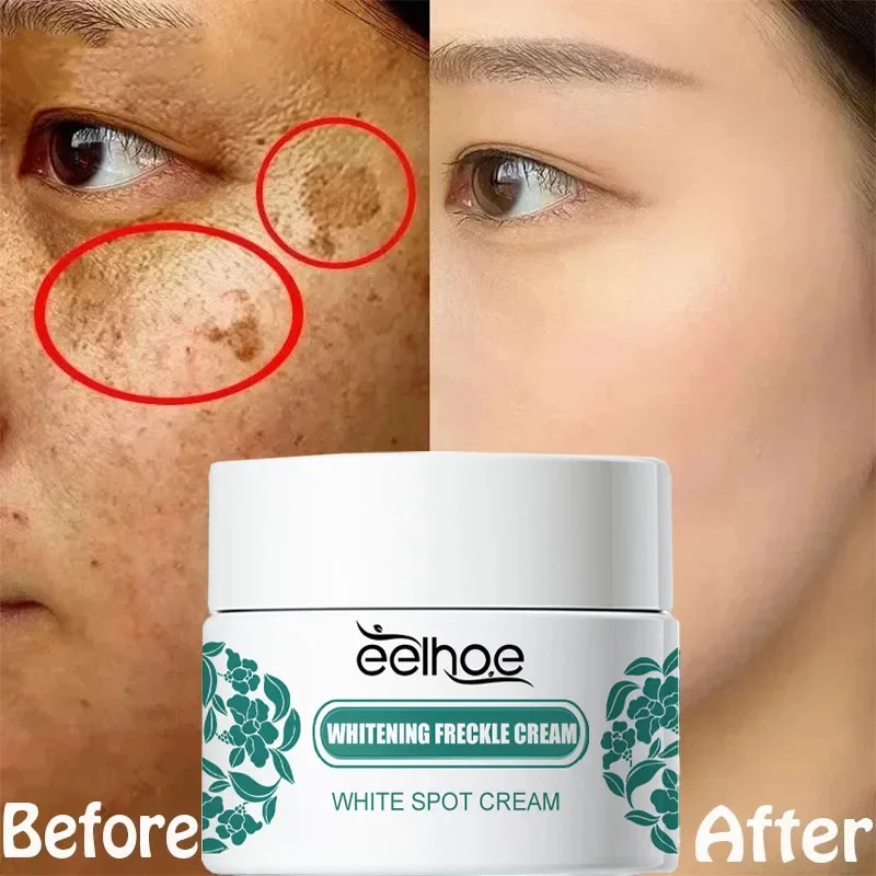 

Niacinamide Melasma Brightening Cream Reduce Melanin Lighten Dark Skin Chloasma Serum Fade Fine Lines Face Korean Care Products