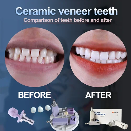 Imagen 2 del producto LODDEN 4 unids/caja vidrio cerámico disilicato de litio B40 bloque laboratorio Dental LT/HT para CAD CAM Sirona Cerec Material de dentista