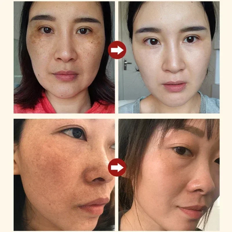Powerful Dark Spots Remover Freckle Whitening Serum Melanin Correcting Anti Pigmentation Brighten Korean Day Night Facial Care