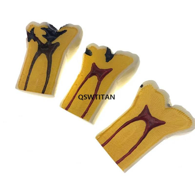 Dental Caries Teeth Comparation Model Dental Study Education Demonstration Teaching Model