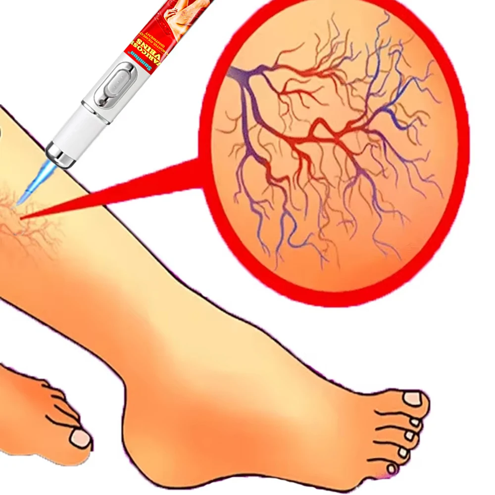 

Laser Pen Soft Scar Scratch Varicose Veins Wrinkle Removal Laser Pen
