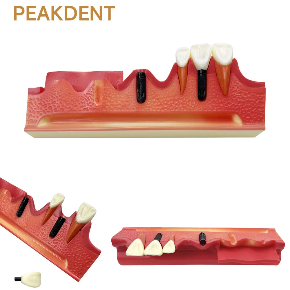 

Модель зубного зуба, обучающая модель имплантататора зуба, стоматологическая модель для демонстрации размещения имплантатов, шаги, образовательная демонстрация