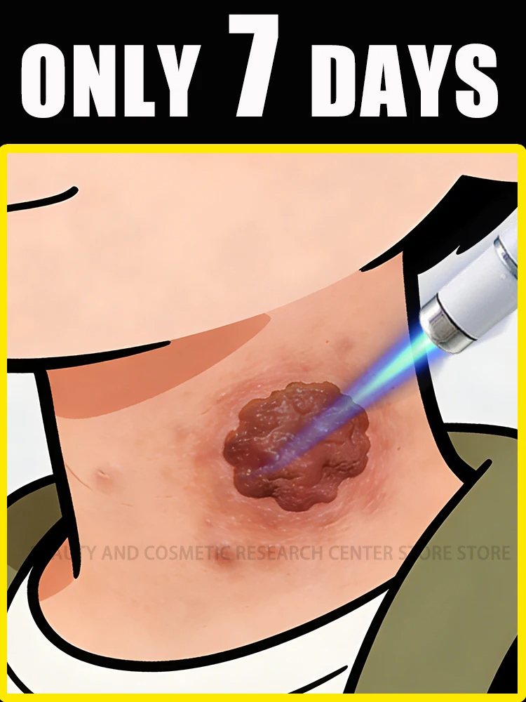 

Точно воздействует на корень бородавки; исчезает естественным образом за 7 дней без следов; безболезненно, в домашних условиях.