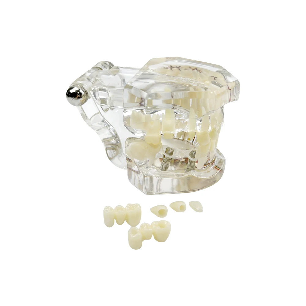 Transparent Disease Teeth Model Typodont Removable Tooth Jaw Model For Studying Research Oral Disease Teaching Demo Medical