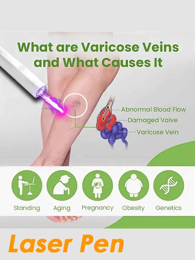 

Laser Therapy Veins Pen For Varicose Veins Chinese Herbal Essence Veins Cream 30g Relieves Spider Veins Leg Care