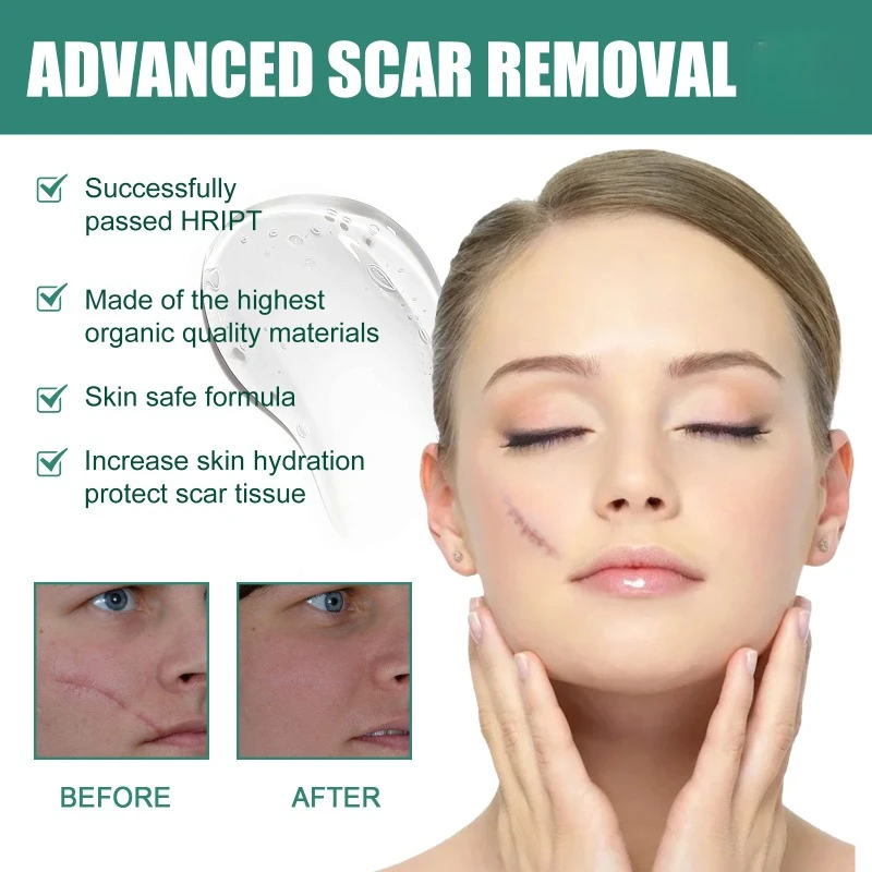 Skin Scar Removal Cream For Burns Surgery Hyperplasia Acne Marks Fade old Scars Stretch Marks Pigment Skin repair Care Gel