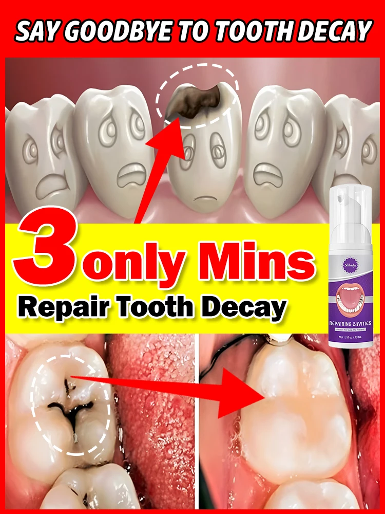 

tooth decay repair tooth repair fast teeth whitening clean teeth teeth repair cavities tooth repair treatment