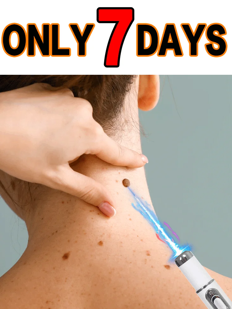Stylo à lumière bleue pour résoudre les verrues corporelles, outils de soins verrues, offre spéciale